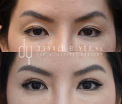 Before And After Asian Rhinoplasty And Upper Blepharoplasty Incisional Upper Blepharoplasty With Supratarsal Facial Plastic Surgery Facial Plastic Rhinoplasty