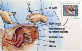 Affordable Laparoscopic Endometriosis Surgery In India Low Cost Endometriosis Surgery In India