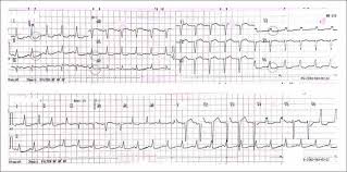 Depresi adalah seseorang yang memiliki ketakutan akan hal hal yang membuat nya takut. Uap Unstable Angina Pectoris Dan Nstemi Non St Elevated Myocardial Infarction Kardiologi Caiherang