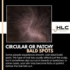 Circular Or Patchy Bald Spots Some People Experience Smooth Coin Sized Bald Spots This Type Of Hair Loss Usually Affects J Hair Loss Balding Scalp Bald Spot