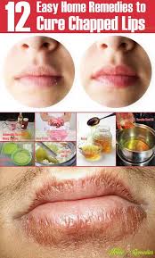 12 Easy Home Remedies For Chapped Lips Natural Pink Eye Remedy Pinkeye Remedies Cure For Chapped Lips