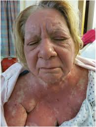 Drug-induced hypersensitivity syndrome/drug reaction with eosinophilia and  systemic symptoms. Part II diagnosis and management