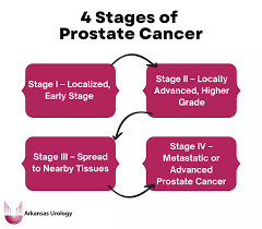 Image result for Prostate Cancer Staging