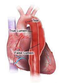 Image result for Aortic Dissection