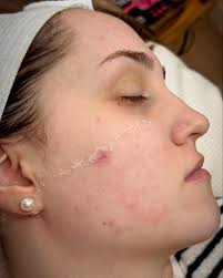 Payne Esthetics, LE, Certified Acne Specialist