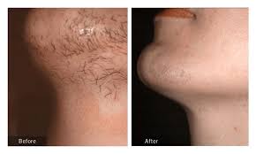 Spray/apply the lemon juice mixture onto your hair until it is completely saturated. Laser Hair Bleaching In Dubai Abu Dhabi Sharjah Spectra Hair Bleaching