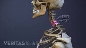 Image result for what is the treatment for c5, c6, c7 nerve narrowing?