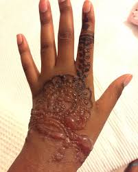 Henna is made naturally from the leaves of henna tree. Ourfavonlinedoc En Twitter Beware Of Black Henna This Is What Some Notorious Black Henna Dyes Can Do To Your Hand Causes Chemical Burns Causes Bad Allergic Reactions Can Give You Ugly