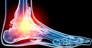 Treatments for tendonitis of the ankle or foot. Foot Pain Symptoms