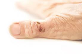 Rheumatoid Nodules Symptoms Causes And Pictures