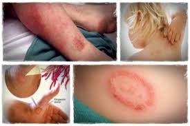 As in the other treatment forms, when taken internally, hydrogen peroxide adds oxygen to the body's internal environment. 8 Best Natural Ringworm Treatment Using Home Remedies