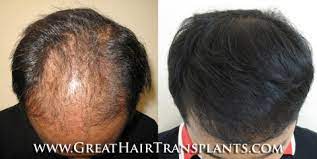 May 30, 2021 · eagles finish third in conference cup. Low Cost Hair Surgery In Louisiana Plaquemines Braithwaite
