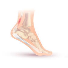Achilles Tendinitis Wikipedia