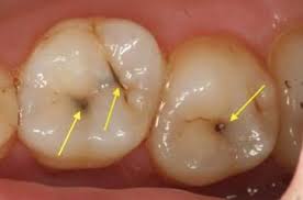 The term usually refers to the space located between an animal's outer covering (epidermis), and the outer lining of the gut cavity, where internal organs develop. What Are Cavities American Pediatric Dental Group Facebook