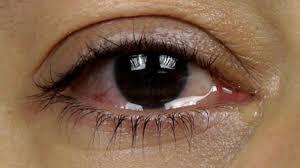 Top 7 Home Remedies For Watery Eyes That You Should Know Watery Eyes Watery Eyes Remedy Home Remedies For Skin