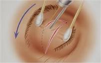 Cosmetic Laser Eyelid Surgery in Boston - boston-pss-seckel