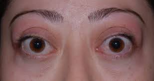 Graves Disease