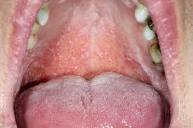 Image result for lichen planus on tongue)