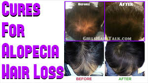 Cures For Alopecia To Get Hair Regrowth Results Fast