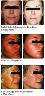 aglow skin care glycolic peels