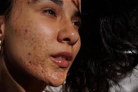 Η ιστορία της Maia Gray με την ακμή και το μήνυμά της