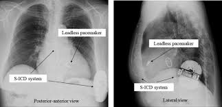 Yes an icd and the procedure is below the umbilicus as. Combination Of A Leadless Pacemaker And Subcutaneous Implantable Cardioverter Defibrillator Therapy For A Japanese Patient With Prosthetic Valve Endocarditis Abstract Europe Pmc