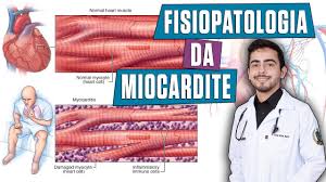 These symptoms may indicate myocarditis as a complication of having the virus. Fisiopatologia Da Miocardite Porth Capitulo 32 Youtube