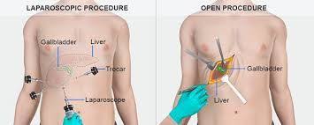 Pin On Professional Cholecystectomy Surgery