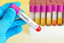 Haemophilia B Treatment: Globaldata Survey Of Treatment Landscape