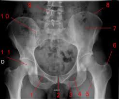 Click image to align with top of page. Pelvis Radiograph W Radiology