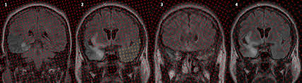 This lesion was seen in all patients as the disease progressed. Plos One A Feasibility Study Of Quantifying Longitudinal Brain Changes In Herpes Simplex Virus Hsv Encephalitis Using Magnetic Resonance Imaging Mri And Stereology