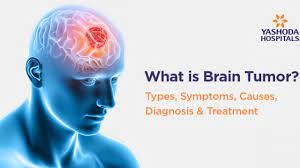 Skip to content search menu this is cancer.net's guide to brain tumor. What Is Brain Tumor Types Symptoms Causes Diagnosis Treatment