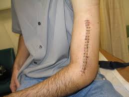 Answered 4 years ago · author has 482 answers and 7.3m answer views. It S Easier Than You Think To Break Your Arm While Arm Wrestling