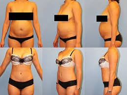 Tips to get insurance to cover your surgery.thanks for watching and. Tummy Tuck Nyc Abdominoplasty Westchester County Ny