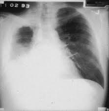 Learn about this uncommon cancer that's linked to asbestos exposure. Preoperative Assessment And Therapeutic Options For Patients With Malignant Pleural Mesothelioma Thoracic Surgery Clinics