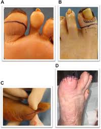 Image result for toe amputation
