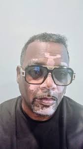 The Vitiligo & Albinism Network