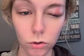 Social media star claims TikTok ban 'gave her shingles and left her blind  in one eye'