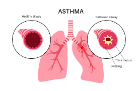 Image result for Allergic Triad