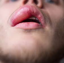 Image result for Angioedema