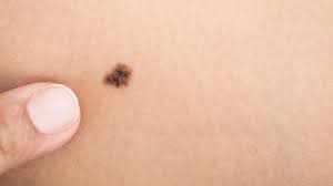skin cancer, a condition in which skin cells grow abnormally, is one of the most common forms of cancer in the world. More Than 11 Moles On One Arm Could Indicate Higher Risk Of Skin Cancer Huffpost Uk Life