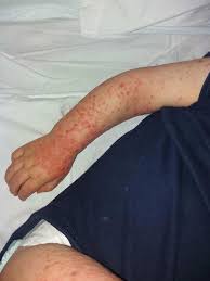 Poison ivy and oak rash. My Baby Was Rushed To Hospital After A Kiss Gave Him Herpes Virus Now I M Begging Parents Not To Make The Same Mistake