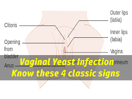 This sounds like a yeast infection, which is not an std. What Does A Yeast Infection Look Like The 4 Classic Signs To Look For