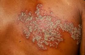 Image result for herpes zoster