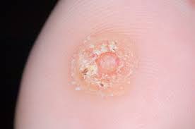 Image result for verrucae filiformes