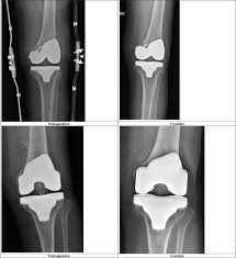 Relative indications for surgical fixation include ulnar nerve entrapment, gross elbow instability. Intraoperative Femoral Condyle Fracture In Primary Total Knee Arthroplasty A Case Control Study In Asian Population Knee Surgery Related Research Full Text