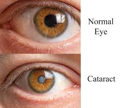 Image result for Cataract Extraction