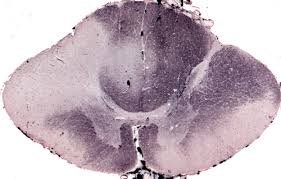 Uhthoff's phenomenon (also known as uhthoff's syndrome, uhthoff's sign, and uhthoff's symptom) is the worsening of neurologic symptoms in multiple sclerosis (ms) and other demyelinating diseases when the body is overheated. Multiple Sclerosis