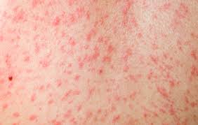 Gejala cacar lainnya adalah seperti banyak penyakit lain yang kurang serius: Peningkatan Kes Measles Demam Campak Di Malaysia Status Sehingga 26 Jun 2016 From The Desk Of The Director General Of Health Malaysia