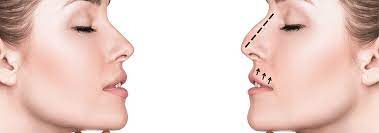 Maybe you would like to learn more about one of these? Top 5 Cheapest Countries For Rhinoplasty Nose Job In The World